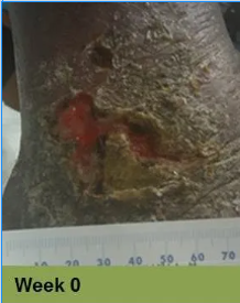 Close-up of a wound on skin, with ruler for scale. Wound is open, bloody, surrounded by inflamed, discolored skin.