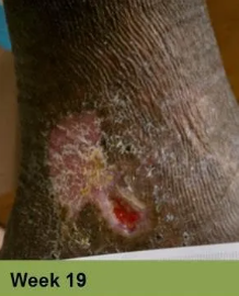 A close-up of a chronic lower leg wound with surrounding skin discoloration, labeled