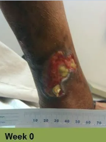 Foot with deep, open ulcer. Skin is swollen and discolored. The ulcer is reddish with exposed tissue.