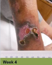 Wound on leg, Week 4. The open sore is reddish-brown with surrounding pale skin.