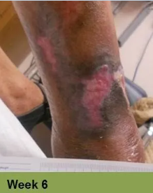 Foot with swollen toes, discolored nails, and signs of skin breakdown; labeled