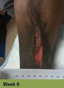Foot with open wound, red tissue, and exposed bone; labeled