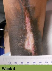 Foot with a wound on the toe, appears to be healing. Text reads