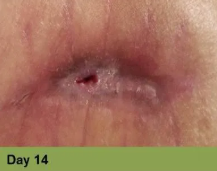 A close-up of a healing incision or wound with a small opening at the center, labeled