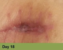 A close-up view of a healing surgical incision on skin, labeled