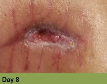 A close-up view of a healing surgical incision site, showing red granulation tissue and skin sutures labeled