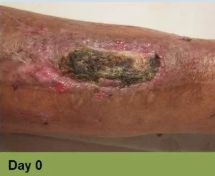 Foot with deep, open ulcer. Skin is swollen and discolored. The ulcer is reddish with exposed tissue.