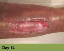 An open leg wound with pink, moist tissue at the center and darkened, discolored skin around the edges, labeled Day 14.
