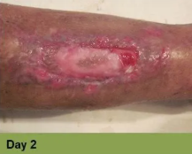 An open wound on a lower leg, showing inflamed, discolored skin surrounding a central area of pale, healing tissue.