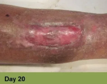 A close-up of a healing skin wound on a person's lower leg, shown on Day 20.