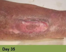 A close-up of a healing skin wound on a leg, showing pink granulation tissue and surrounding darkened skin. Day 35 label.
