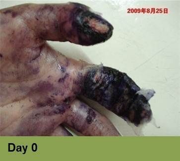 Foot with a large, open wound; measured as 120 mm x 70 mm. The wound is red and brown, and healing progress is at