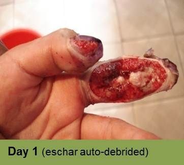 A close-up of a foot with a deep, open wound. Red, raw tissue visible. “Week 9” is in a green bar below.