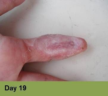 A finger with a pale, healing scar on the skin, labeled