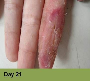 A close-up of a human finger showing raw, red, dry, and peeling skin, labeled
