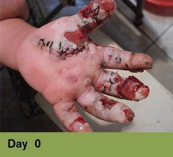 Heel ulcer, open wound. Brown skin with a deep, red sore. Week 0.