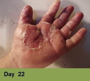 A palm of a hand with significant skin peeling, redness, and dark bruising on the fingers, labeled