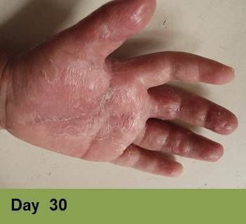 A hand showing peeling, dry, and reddened skin on the palm and fingers, labeled