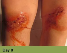Close-up of a wound on skin, with ruler for scale. Wound is open, bloody, surrounded by inflamed, discolored skin.