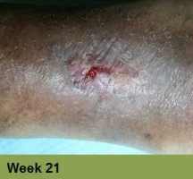 Close-up of skin on a lower limb showing an open, inflamed lesion surrounded by darkened, textured, and dry tissue.