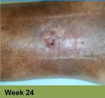 A close-up view of a healing skin lesion on a limb, showing darkened pigmentation and scar tissue, labeled 