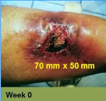 Foot with deep, open ulcer. Skin is swollen and discolored.  The ulcer is reddish with exposed tissue.