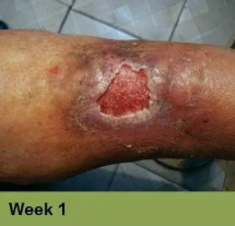 Wound on leg, Week 4.  The open sore is reddish-brown with surrounding pale skin.