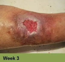 Foot with a deep, open wound, swollen toes, and discoloration.