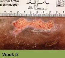 Foot with a wound on the toe, appears to be healing. Text reads 