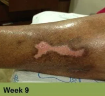 Foot with healed wound, likely diabetic ulcer, at 8-week mark. Skin is yellowed with scarring.