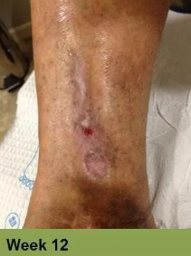 Heel with a large, open sore, showing signs of tissue damage. The surrounding skin is discolored.