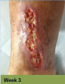 A close-up of a foot with a deep, open wound. Red, raw tissue visible. “Week 9” is in a green bar below.