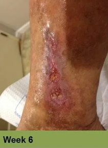 Foot with open ulcer, red tissue, yellow and dry skin, stage 15.