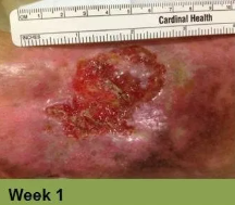 Foot with a deep, open wound on the heel, surrounded by discolored skin.