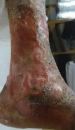 Heel ulcer, open wound. Brown skin with a deep, red sore. Week 0.