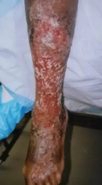 Foot with a large, open wound, wrapped in clear dressing; labeled 