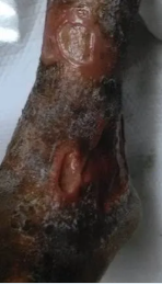 Foot with a deep, open wound on the heel, surrounded by discolored skin.
