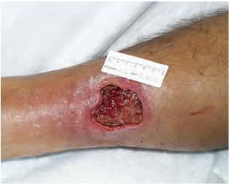 Ointment