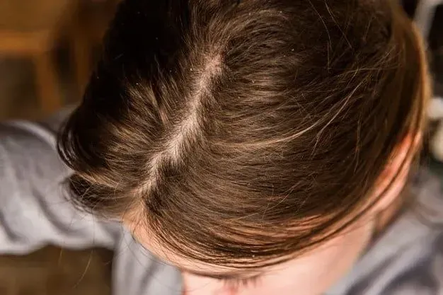 Primer plano de la cabeza de una persona con una raya visible en su cabello castaño.