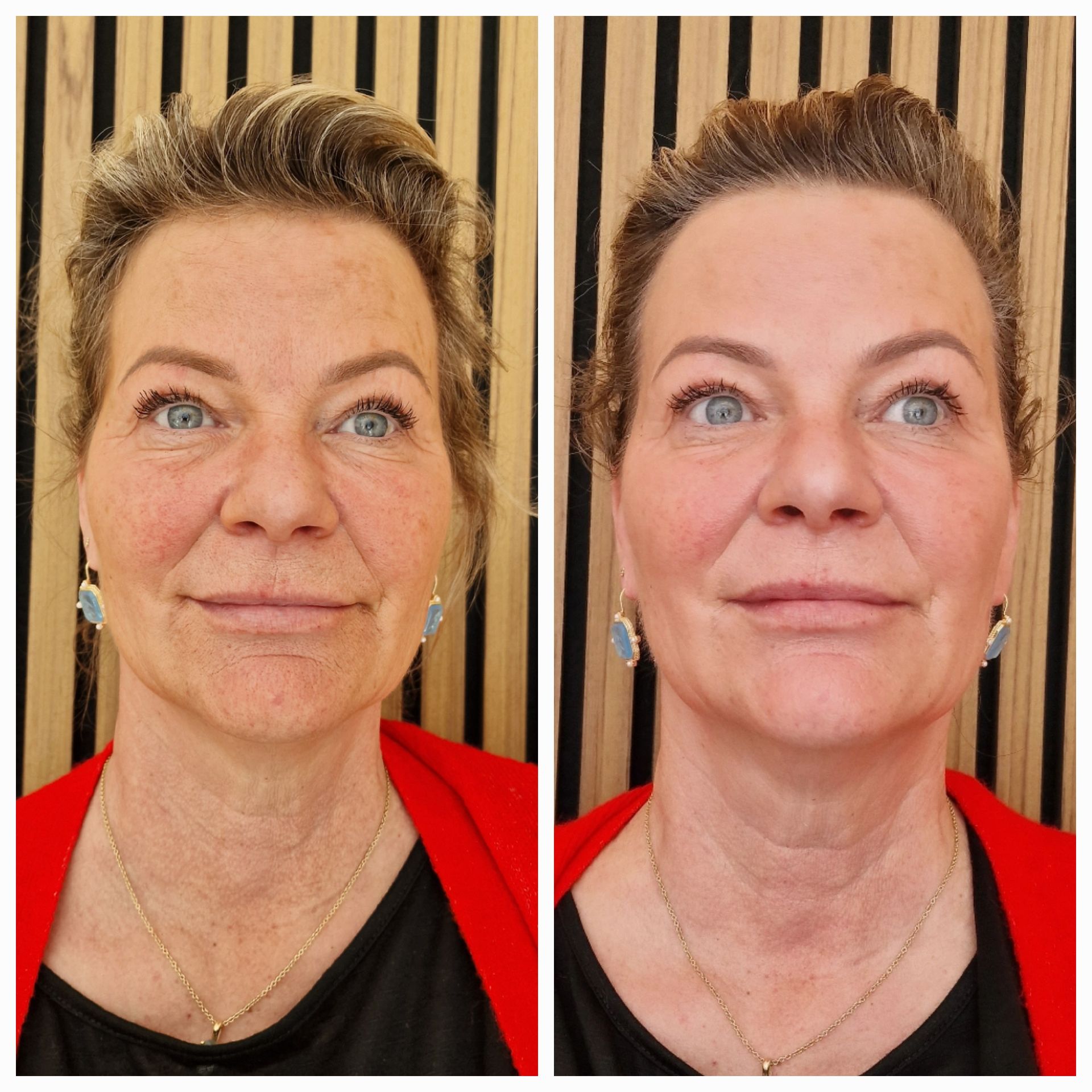 Before and after Gustil Facial Lifting