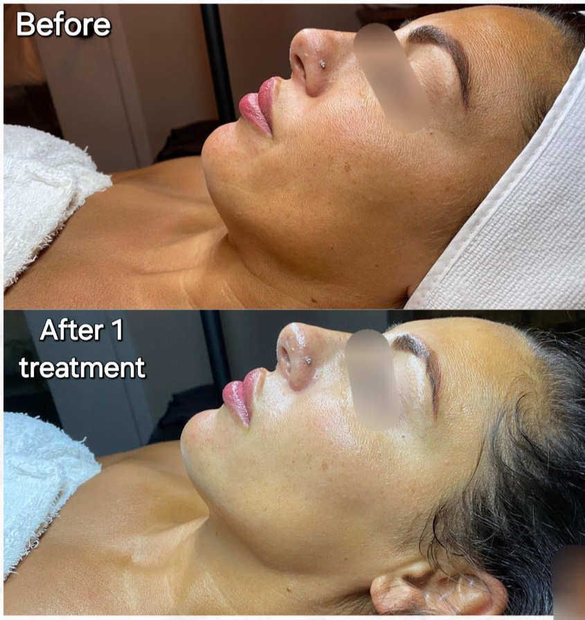 Before and after Hyperpigmentation 4
