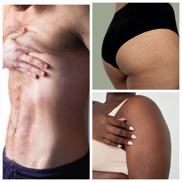 Stretch Mark Treatment
