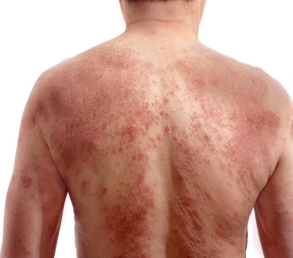 Soft visual for eczema