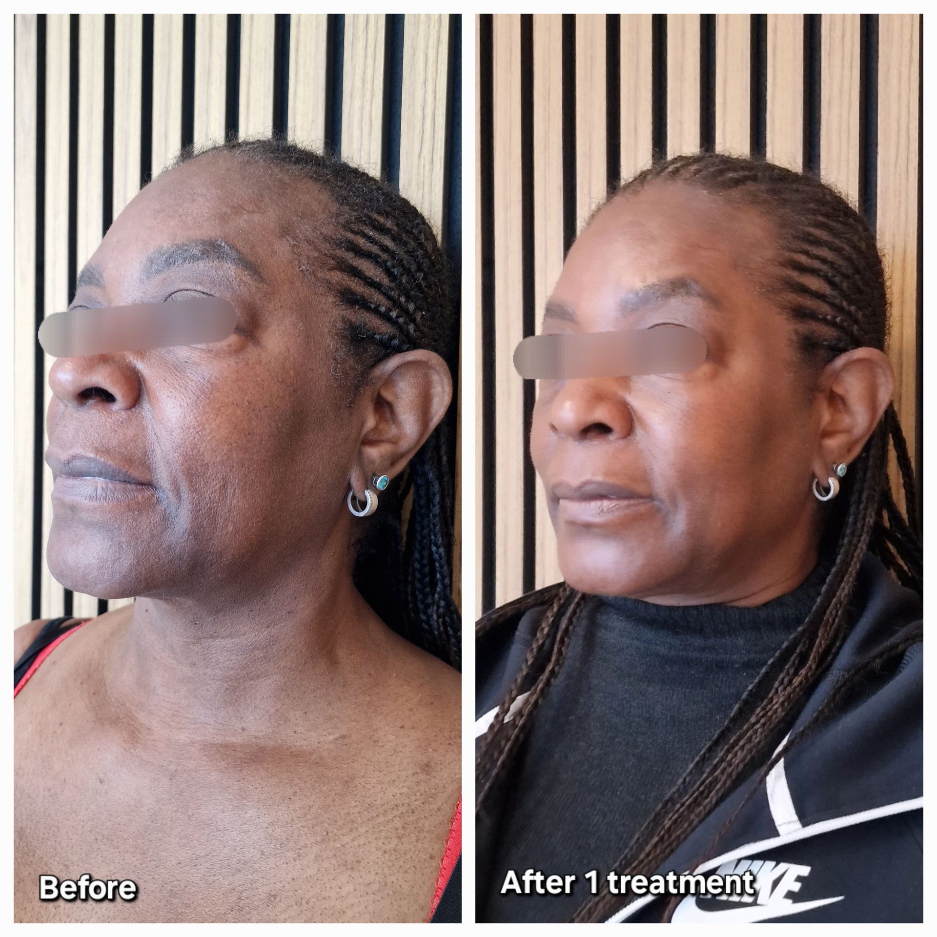 Before and After Gustil Facial Lifting