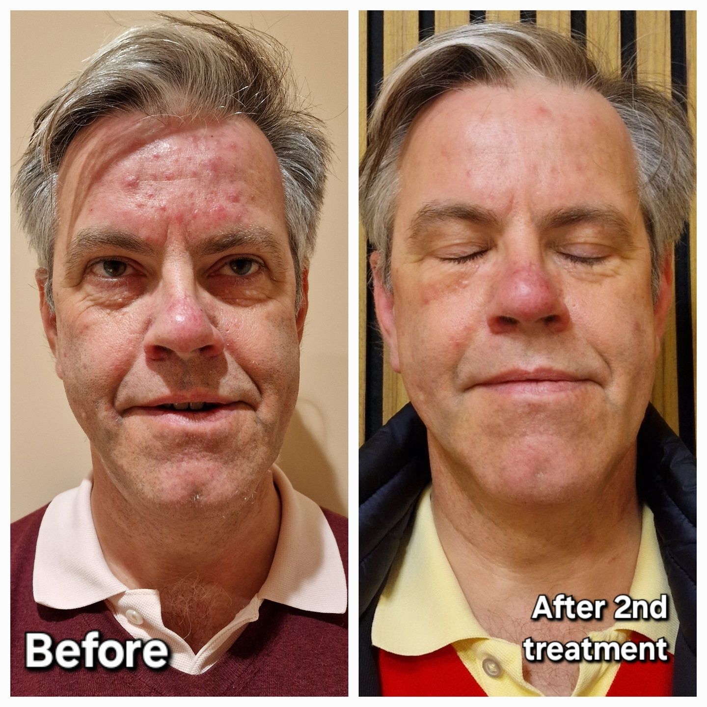 Before and after 1