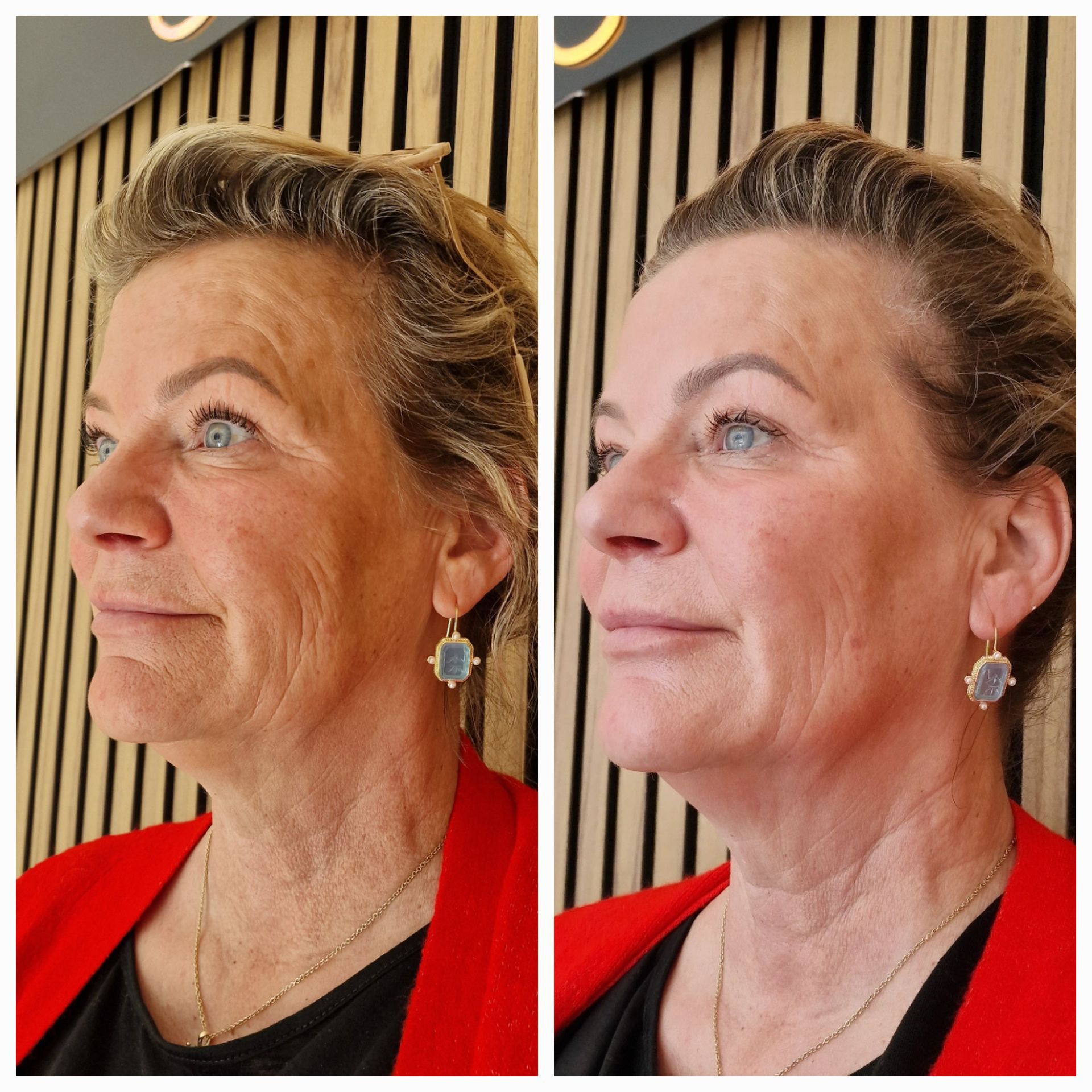 Before and after Gustil Facial Lifting