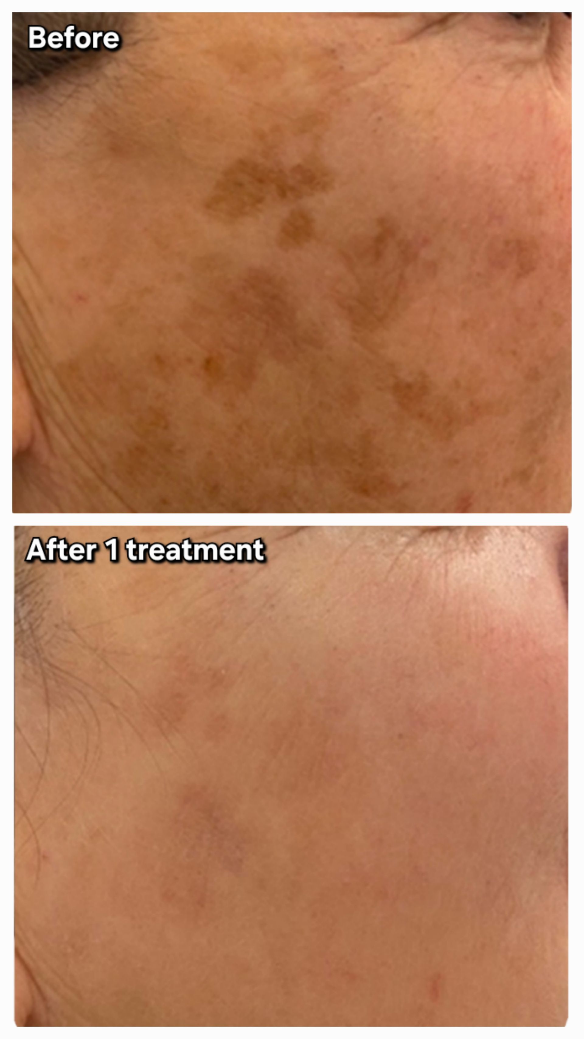 Pigmentation and dark spot treatment at Gustil Aesthetics Amsterdam