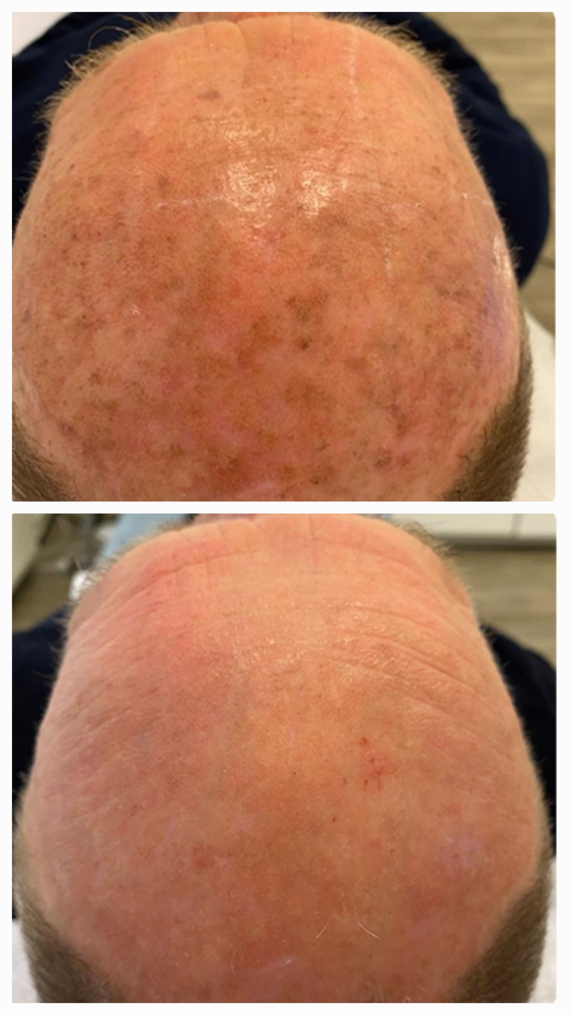 Before and after pigmentation treatment result