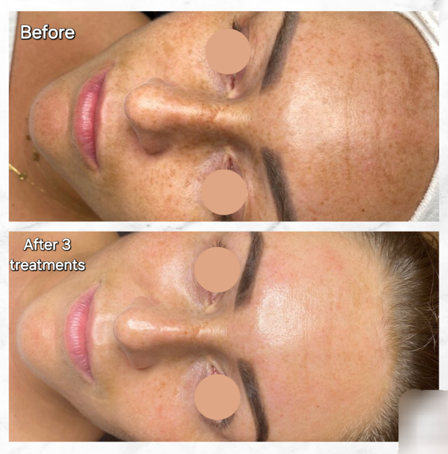 Before and after Hyperpigmentation 2
