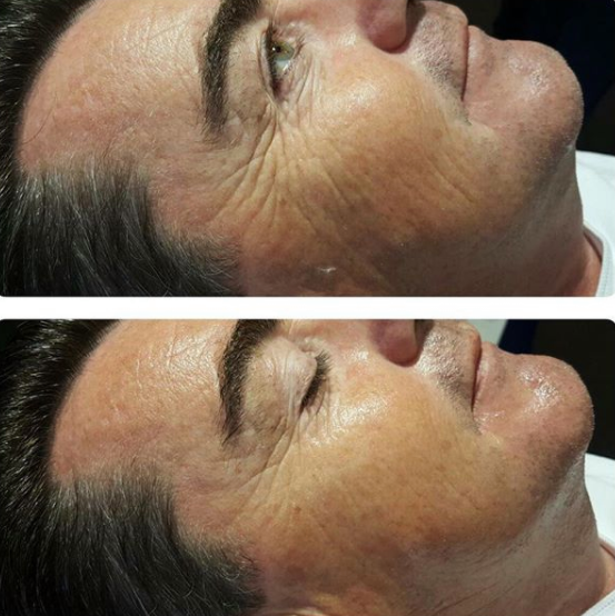 Before After Radiofrequency